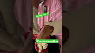 Cannula insertion nurses shorts doctor mbbss neet neetstudentsmbbsstudnetssubscribeytshorts [upl. by Gustave858]