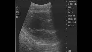 Ultrasound  Resting amp Irregular with Pushes [upl. by Aiet163]