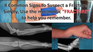 FRACTURE A Mnemonic Guide to Suspect a Fracture With Fraterne ZU medicalexcellencecenter [upl. by Ahsiak817]