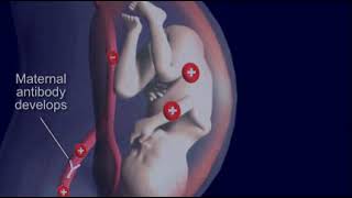 Jaundice Hemolytic Disease quotErythroblastosis fetalisquot in Newborn [upl. by Nessie115]