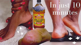 how to remove dead skin from your feet naturally at home 2021 cracked heels home remedy [upl. by Floria]