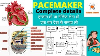 Pacemaker Hindi mekyu lgate h pacemakerpacemaker heart heartbeat [upl. by Nostrebor]