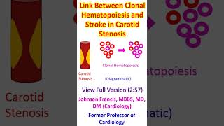 Link Between Clonal Hematopoiesis and Stroke in Carotid Stenosis [upl. by Patterman]