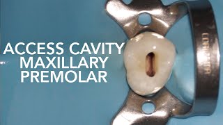 Pre Clinical Endodontic  Access Cavity of Maxillary Premolar [upl. by Dnalor602]