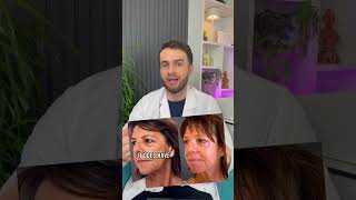 Watch the pros and cons of Phenol Peel phenolpeel antiaging acnescars atrophicscars skincare [upl. by Gavrila]