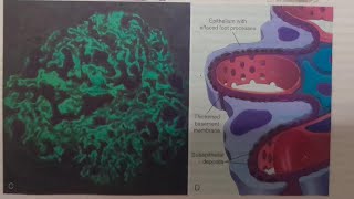 Membranous Nephropathy NephroticSyndrome  SPECIAL PATHOLOGY [upl. by Kushner]