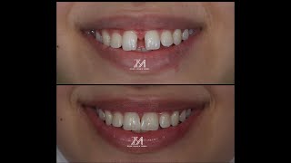 diastema closure using bioclear method [upl. by Kooima]