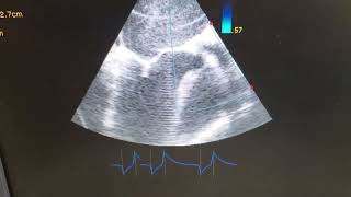 Échographie TransOesophagnienneETO Sténose Mitrale Maladie Aortique au Cameroun 25 ans Siemens [upl. by Dorelle]