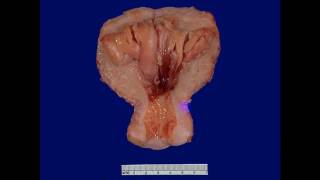 Pathology  dr Nafeaa  Neoplasia كل ما تريد عن الأورام [upl. by Solly898]