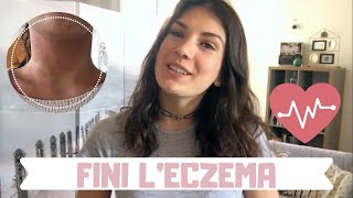 FINI LECZEMA  Mes conseils pour enfin sen débarrasser [upl. by Airakaz119]