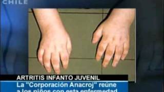 Artritis Idiopatica Juvenil síntomas causas terapias CNN Chile 2009 [upl. by Refinaj]