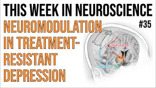 TWiN 35 Neuromodulation in treatmentresistant depression [upl. by Ellehsyt]