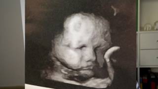 30 Week Scan Theres Something Wrong With The Baby  My Pregnancy  Aussie Mum [upl. by Htur]