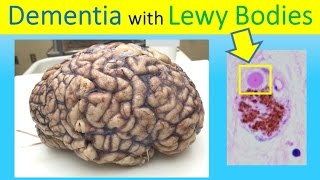 Robin Williams killer Dementia with Lewy Bodies Human Brain  Alzheimers amp Parkinsons Disease [upl. by Delanos]