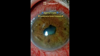 Granulomatous Keratic Precipitates Anterior Uveitis [upl. by Marcile]