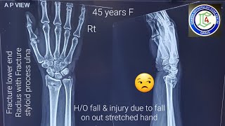 Ligamentotaxis method  Fracture Lower end Radius  Closed reduction under Short GA  Adamya Hosp Vd [upl. by Aneelas]