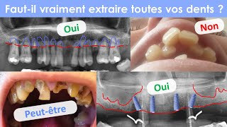 All on 4  extraction totale [upl. by Shay]