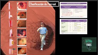 ✅ CLASIFICACIÓN DE FORRESTHDAúlcera péptica Mnemotecnia visual [upl. by Thanos]