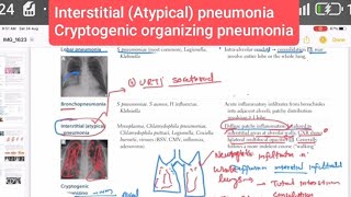 Interstitial Atypical pneumonia and Cryptogenic organizing pneumoniaRespiratory 49  USMLE step 1 [upl. by Einnol]