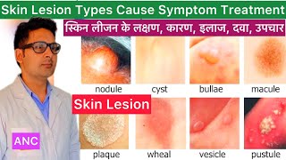 Skin Lesions Cause Symptom Diagnosis Treatment in Hindi  Skin Lesion  What is Skin Lesion  Skin [upl. by Siahc817]