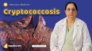 Cryptococcosis  Infectious Medicine Video Lectures  Medical Education  VLearning [upl. by Anisamoht]