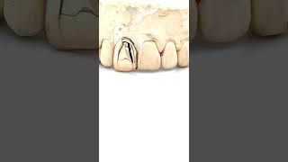 Top Reasons Rappers Love Single Tooth Gold Grillz [upl. by Hanleigh]