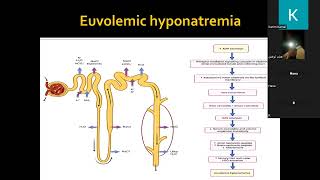 Chronic hyponatremia Dr Kareem Kamal [upl. by Taddeo]