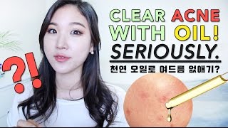 CLEAR ACNE WITH OIL • BEST Oils for Acne Prone Skin [upl. by Lester397]