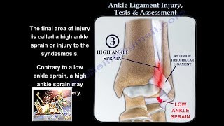 Ankle Ligament Injury evaluation and tests  Everything You Need To Know  Dr Nabil Ebraheim [upl. by Coral33]