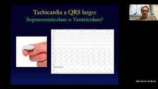 GIS4Plus  Update sullextrasistolia ventricolare in Medicina Interna [upl. by Neelyaj337]