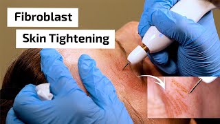 What is Fibroblast Skin Tightening  Prime Plasma [upl. by Anastasie]