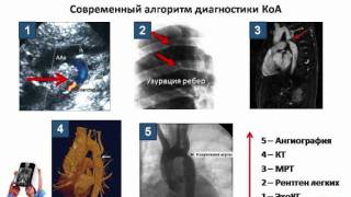 Коарктация аорты симптомы диагностика лечение [upl. by Daisi]