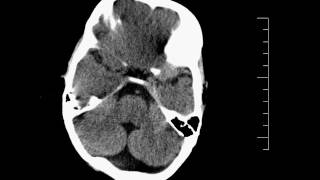 Agenesis Corpus Callosum  Dandy Walker CT Head [upl. by Celtic]