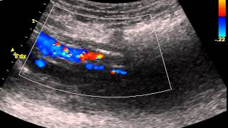 ILIAC ARTERY STENOSIS [upl. by Merceer]