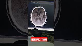 Ischemic Stroke ischemicstroke ctbrain [upl. by Aicilak12]