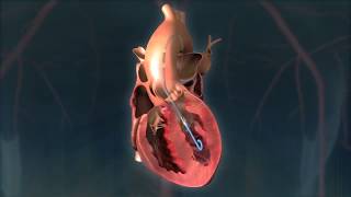 Impella  Eternal Hospital  Worlds Smallest Heart Pump [upl. by Wheaton]