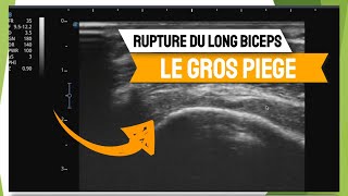 Le gros piège de la rupture du tendon du long biceps [upl. by Irrac]