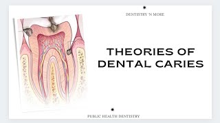 THEORIES OF DENTAL CARIES [upl. by Ridan]