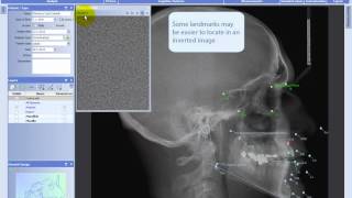 Making analyses in Planmeca Romexis® Cephalometric Analysis module [upl. by Canice]