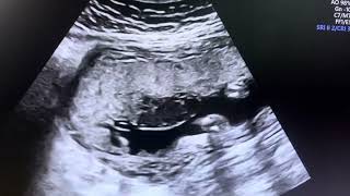 Sub chorionic hematoma ultrasound  placental side pregnancy bleeding sonography  ardms  abortion [upl. by Avah492]