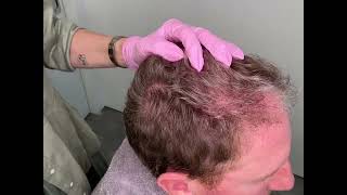 MicroNeedling for Hair Restoration [upl. by Sofer]