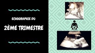 ECHOGRAPHIE DU 2ème TRIMESTRE [upl. by Narat935]