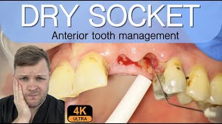 Alveolar Osteitis Management  4K Resolution [upl. by Drue]