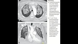 Daptomycin assoziierte eosinophile Pneumonitis [upl. by Greenlee797]