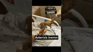 Asterixis flapping hand tremor asterixflappingtremoricucardiologistashortvideohandtremor [upl. by Roleat]