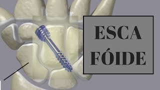 Cirurgia Escafoide com Anestesia Local [upl. by Alaet]