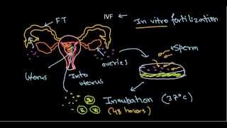 In vitro fertilization and embryo transfer IVF procedure [upl. by Ebag]