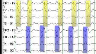 EEG Reading Rounds BIPLEDS [upl. by Qahsi]