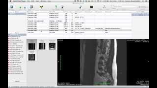 Tutorial 021 OsiriX How to Edit Series Number [upl. by Egarton]