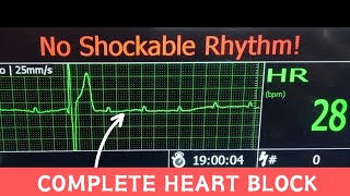 Third Degree AV Block  Complete Heart Block on Hospital Monitor cardiology [upl. by Alimat]